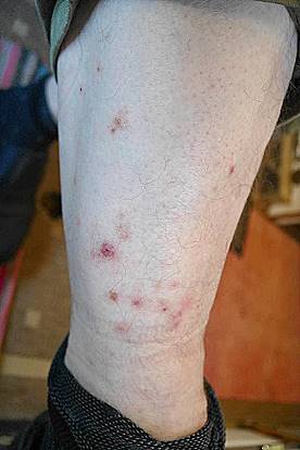 Flohbisse sind viel unangenehmer ...